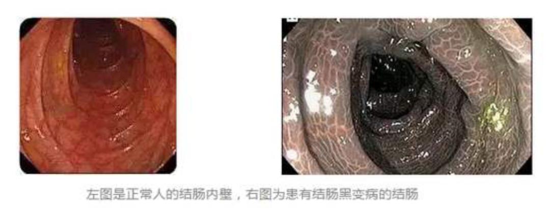 绂忓窞濂冲瓙鑲犲瓙鍙樷€滆惫绾光€濓紝灏卞洜涓哄ス闀挎湡鍚冭繖涓€氫究鍏婚鈥︾粡甯镐究绉樼殑娉ㄦ剰浜?/span&gt;