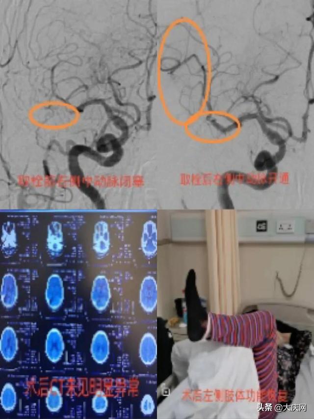 哈尔滨两位高龄老人相继突发意识模糊、言语不清.....医生：此病发病率高、症状难以察觉