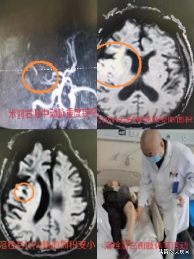 哈尔滨两位高龄老人相继突发意识模糊、言语不清.....医生：此病发病率高、症状难以察觉