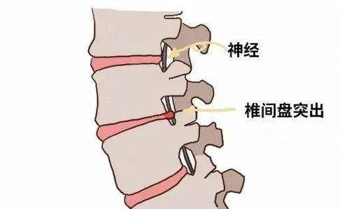 “腰突”术后活动自如！该技术在光华医院已被广泛使用