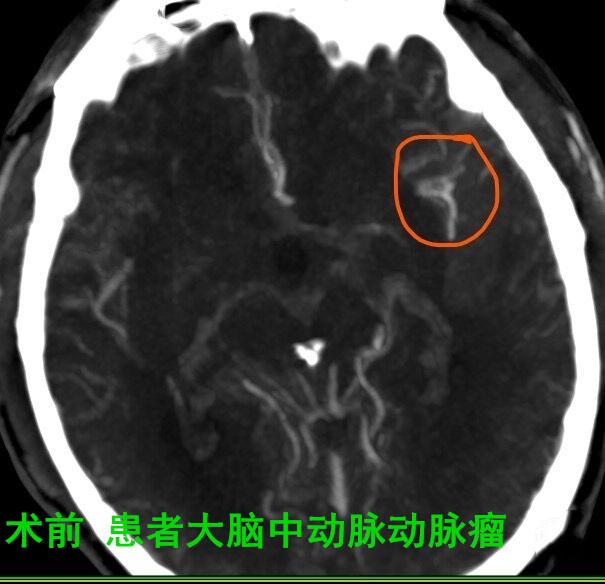 壮男脑动脉瘤破裂命悬一线 医生紧急“拆弹”救命