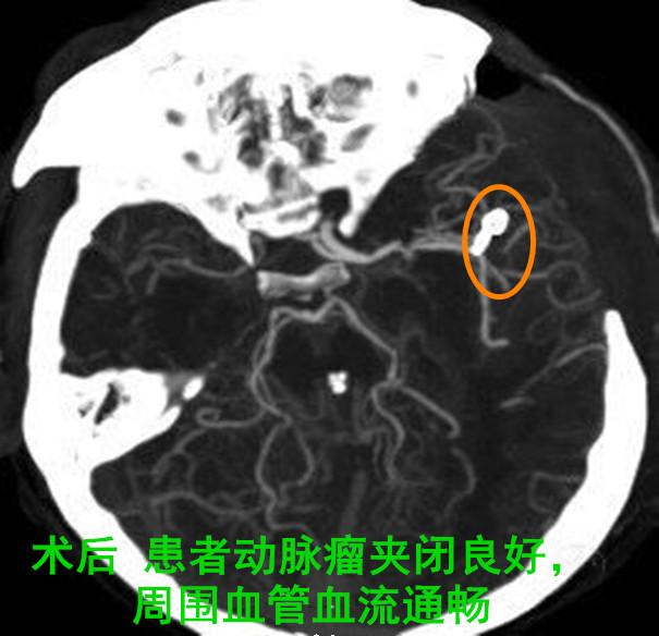 壮男脑动脉瘤破裂命悬一线 医生紧急“拆弹”救命