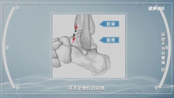 踝关节受损怎么办？科学讲解，健康运动｜健康之路