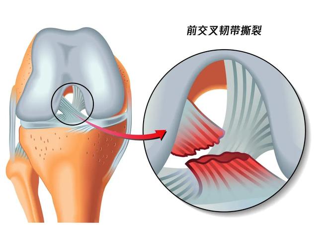 膝关节疼千万别硬扛！这9个膝盖保养知识，学会就赚到