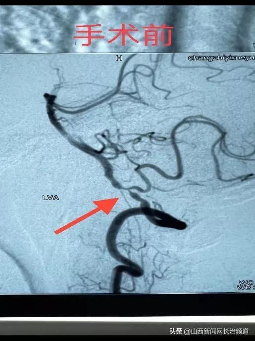 长治医学院附属和济医院：高难度椎动脉V4段支架成形术 打通“命悬一线”的狭窄血管