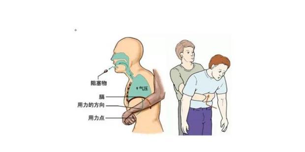 呼吸道异物阻塞怎么办？急救医生强调：学会它，关键时刻能救命!