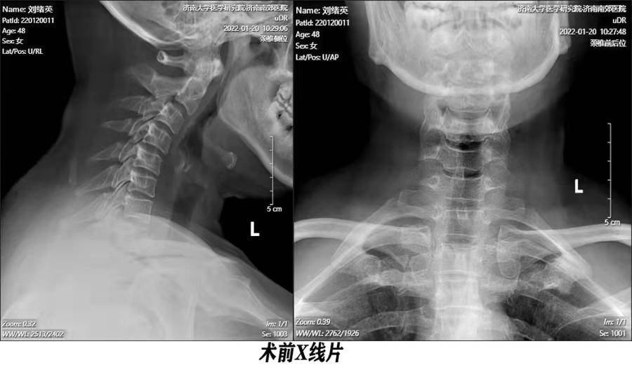 有图有真相——神经根型颈椎病在这里康复