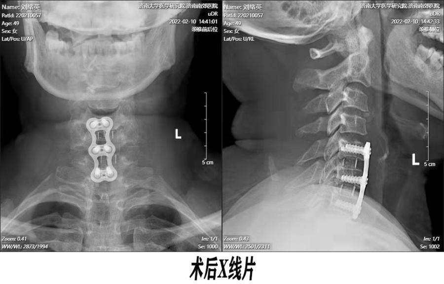 有图有真相——神经根型颈椎病在这里康复