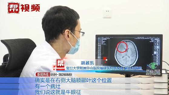 喜食切片生肉，二十岁小伙突发癫痫险致命！元凶竟是一种虫！