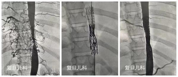 8岁姑娘全身水肿走路气喘 上海专家找出“元凶”挽救生命