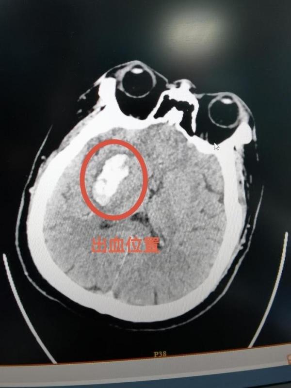 280／130mmHg！男子血压爆表脑出血，这些坑你中过几个