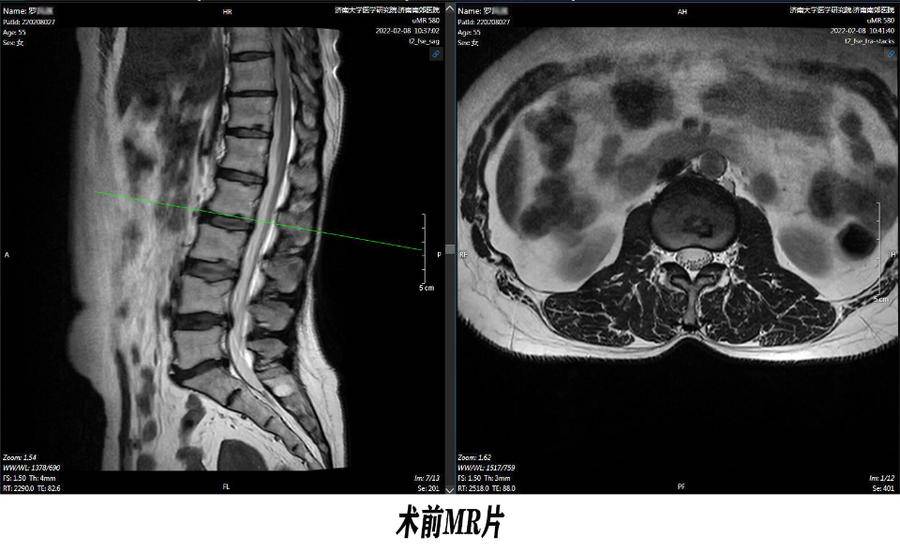 椎间盘微创手术，更小的创伤，更快的恢复