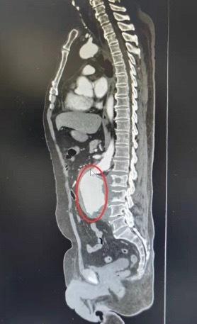 间歇性腰痛误为肾结石，想不到竟是这种致命急症