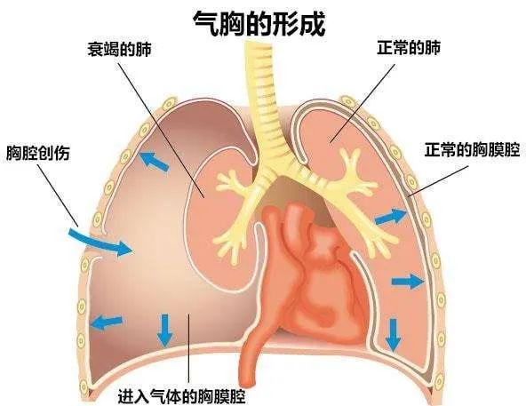 注意！肺真的能被气“炸”