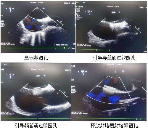 【突破】填补心房“小洞”，大足区人民医院首例“经食管超声引导下卵圆孔未闭封堵术”