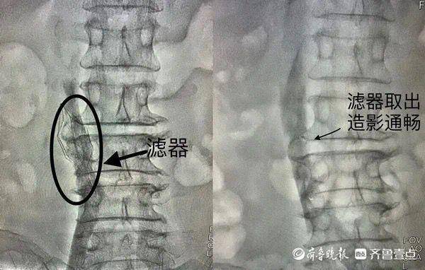 聊城市中医医院介入科成功完成一例下腔静脉滤器植入＋取出术