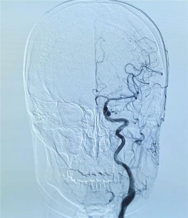 男子每天吸40根烟引发脑梗死！