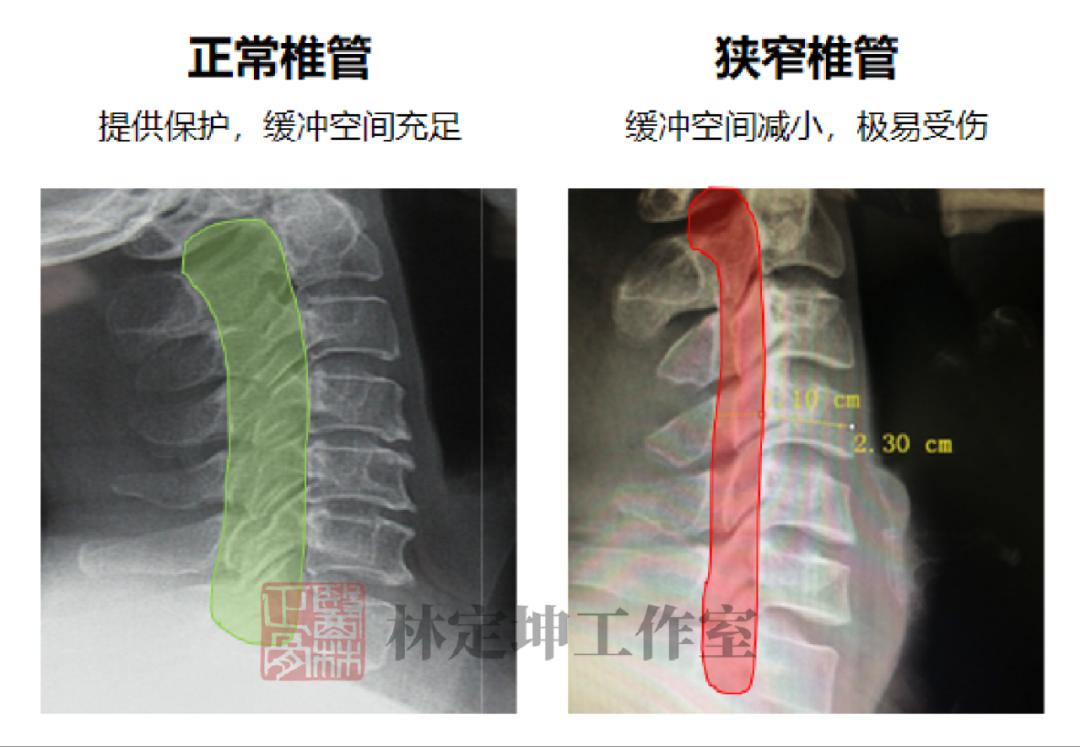 医林正骨丨不用枕头能治颈椎病？