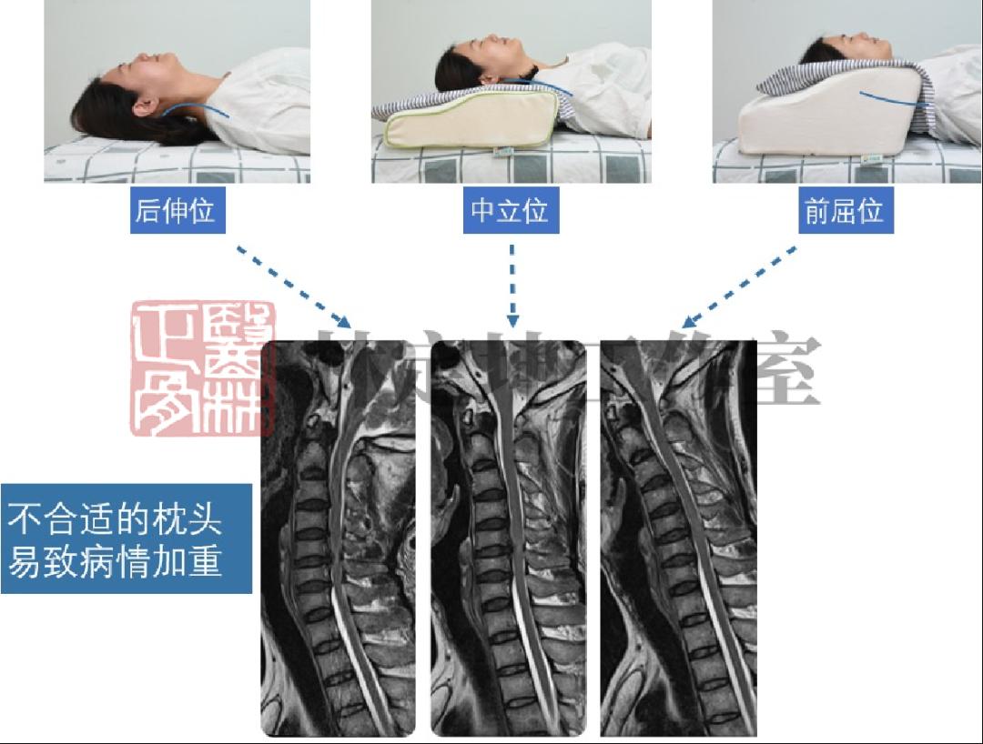 医林正骨丨不用枕头能治颈椎病？