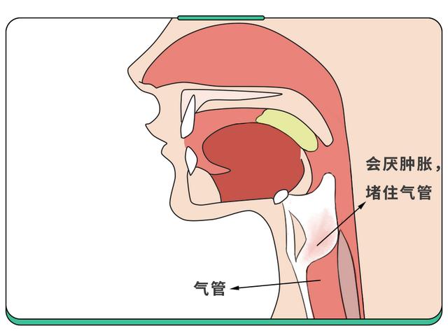 5岁娃嗓子疼进ICU！这病春季高发，重症率高，小孩大人都得防