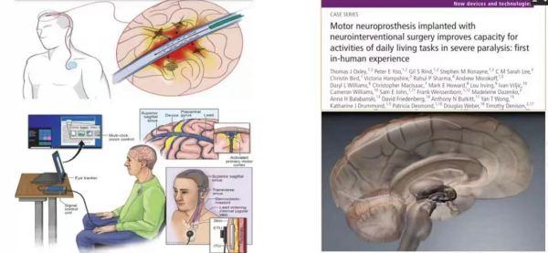 脑机接口、iPS有望助“渐冻人”迎来春天，这个研讨会上专家透露……