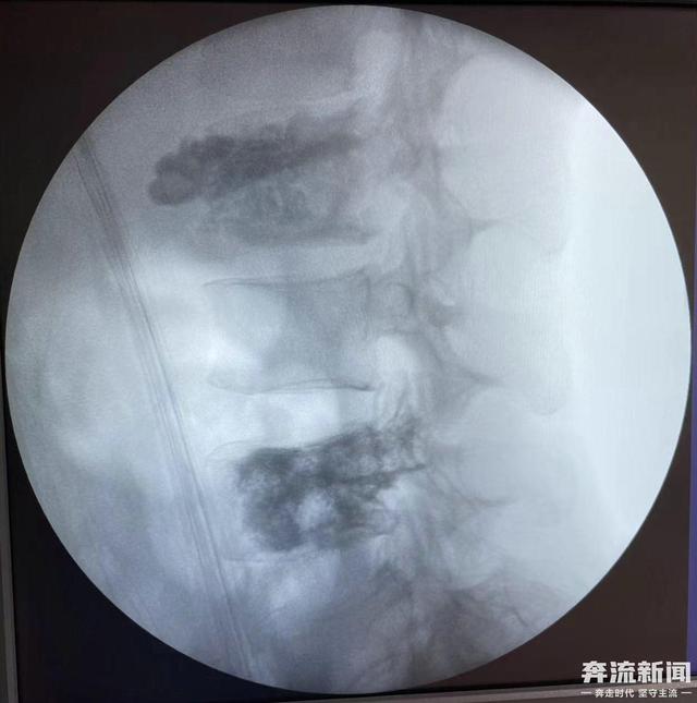 兰大二院成功实施一例肾癌并腰椎骨转移瘤手术