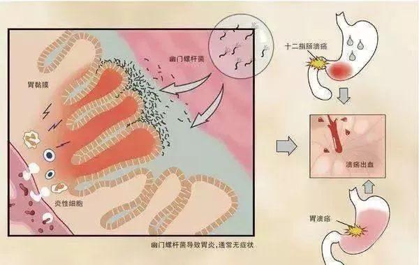 被列为明确致癌物！近60%国人已感染！如何才能避免？