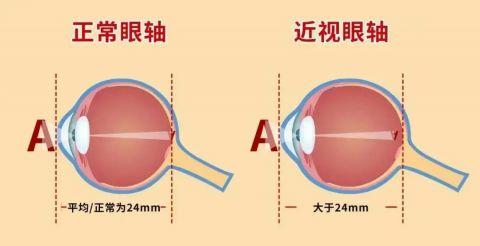 这件事情很容易加重近视，很多人都忽略了