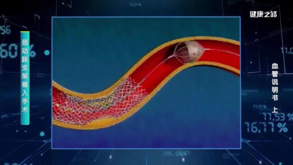 一过性黑蒙、突然失语、突然偏瘫，这是颈动脉在报警！｜健康之路