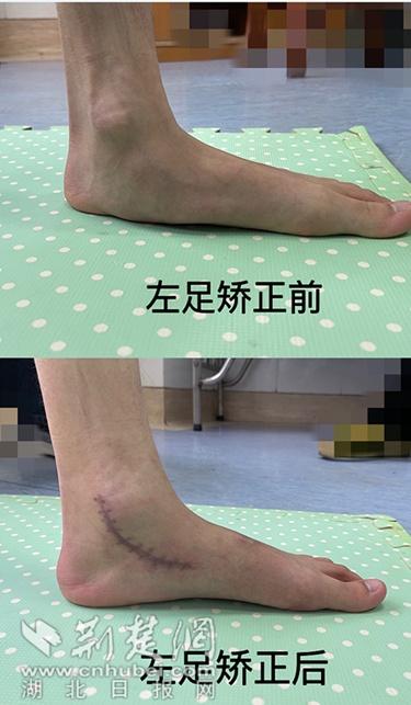 高中生跑步双腿疼痛难忍病根竟在脚掌上