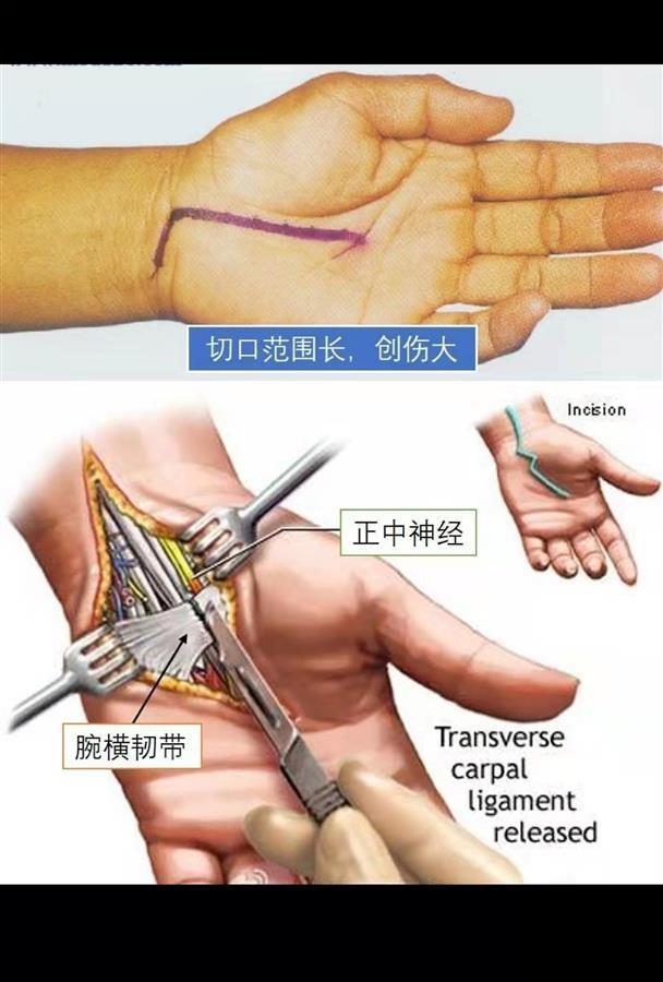 睡梦中经常被“麻醒”医生用微创手术赶走“鼠标手”