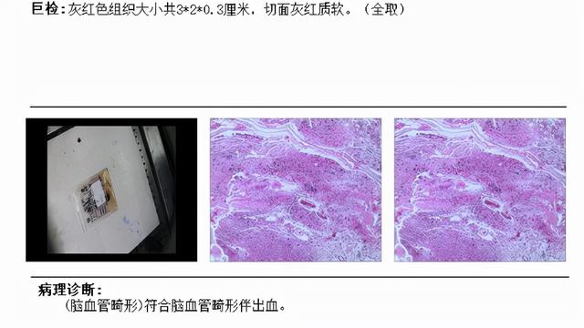 颞叶癫痫患者在信阳市中心医院成功救治