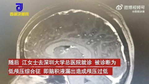 女白领头痛站不住查出大脑漏积液 医生用自身血液堵上漏点