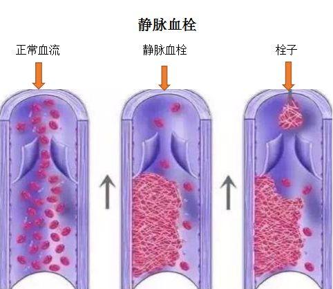 VTE，沉寂的健康“杀手”