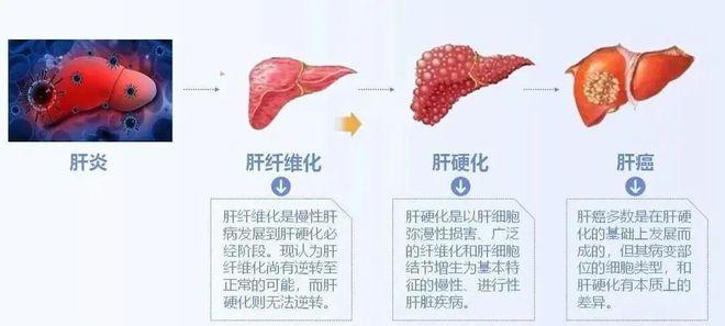 全国爱肝日 青岛内分泌糖尿病医院专家科普肝脏健康知识