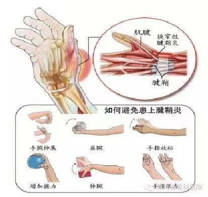 长时间玩手机？这个疾病是骨骼在“报警”