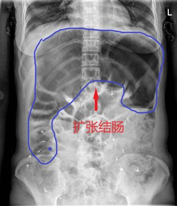 41岁女子便秘5年，肚涨如怀孕，济南市中心医院微创手术解难题