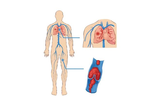 急性肺栓塞可谓是个“致命杀手”，骨折后活动患肢要小心