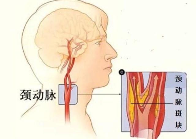 消除颈动脉中“沉默杀手”