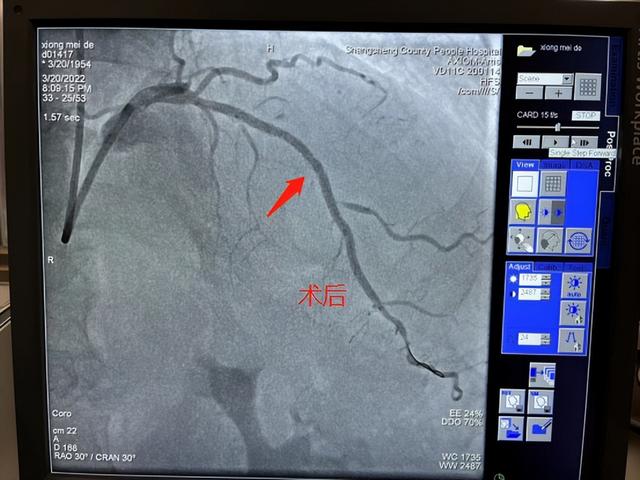 商城县人民医院心脏介入手术精进不休，再上新台阶！?