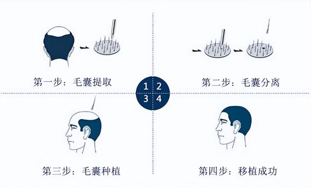 专利精密仪提取立体种植，3D植发你了解多少？