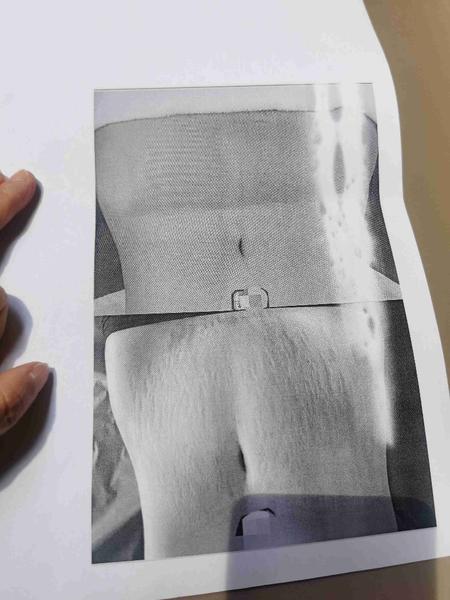 45元体验妊娠纹修复莫名买了1.7万余元套餐(图4)