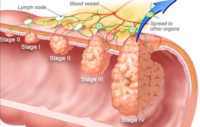 属于发生在直肠下2/3的直肠癌,也就是大概距离大家的肛门10cm左右的