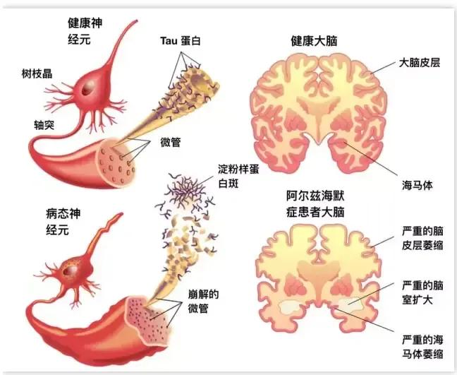 儿童血脑屏障图片