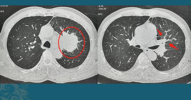 这位老人平时身体还好,因为咳嗽,胸口发闷4天,做了个肺部ct,发现5