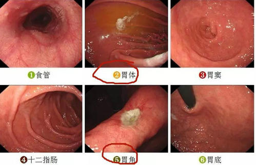 胃底静脉曲张胃镜图片图片