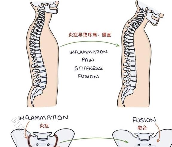 强直性脊柱炎是什么原因导致的?