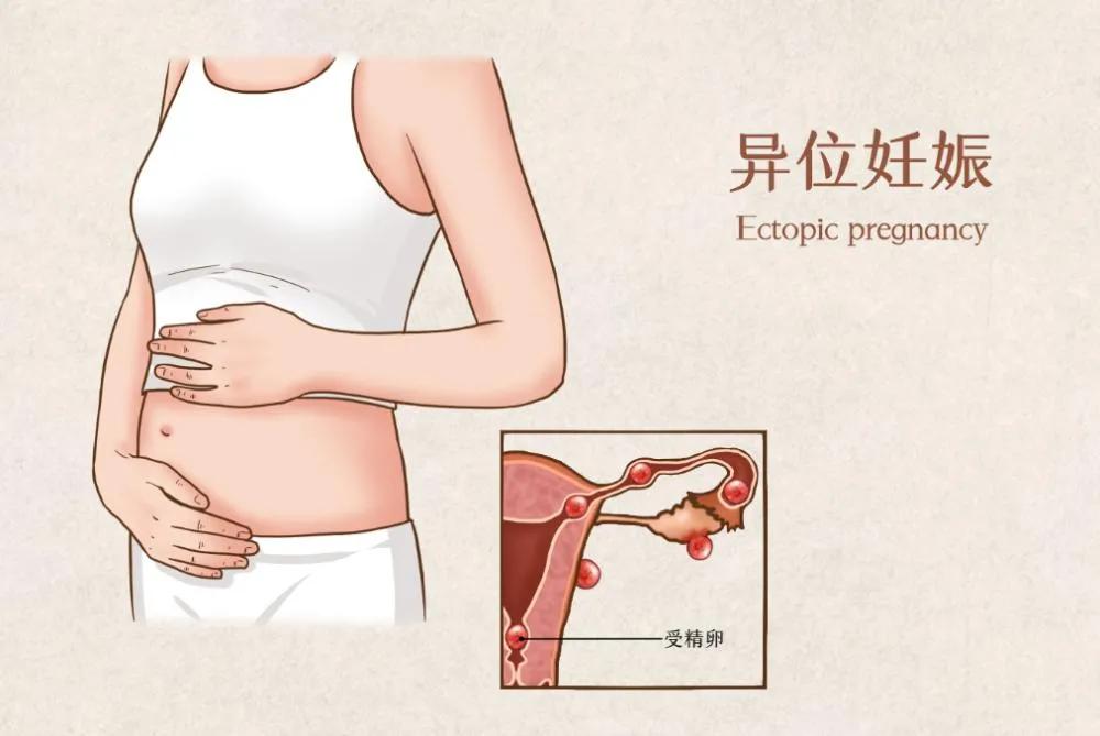 宫外孕发病原因及预防