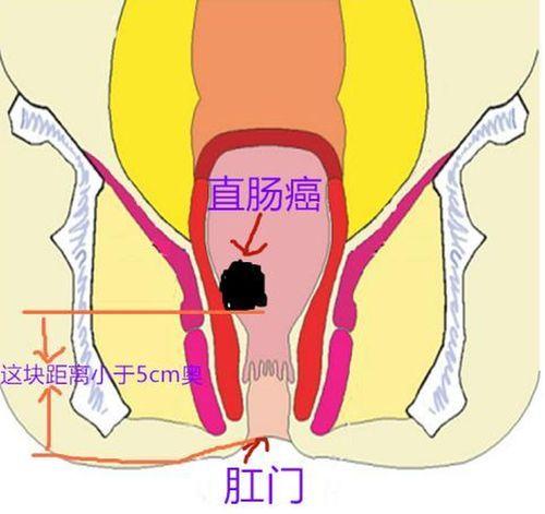 不停放屁是直腸癌嗎這些食物不能吃