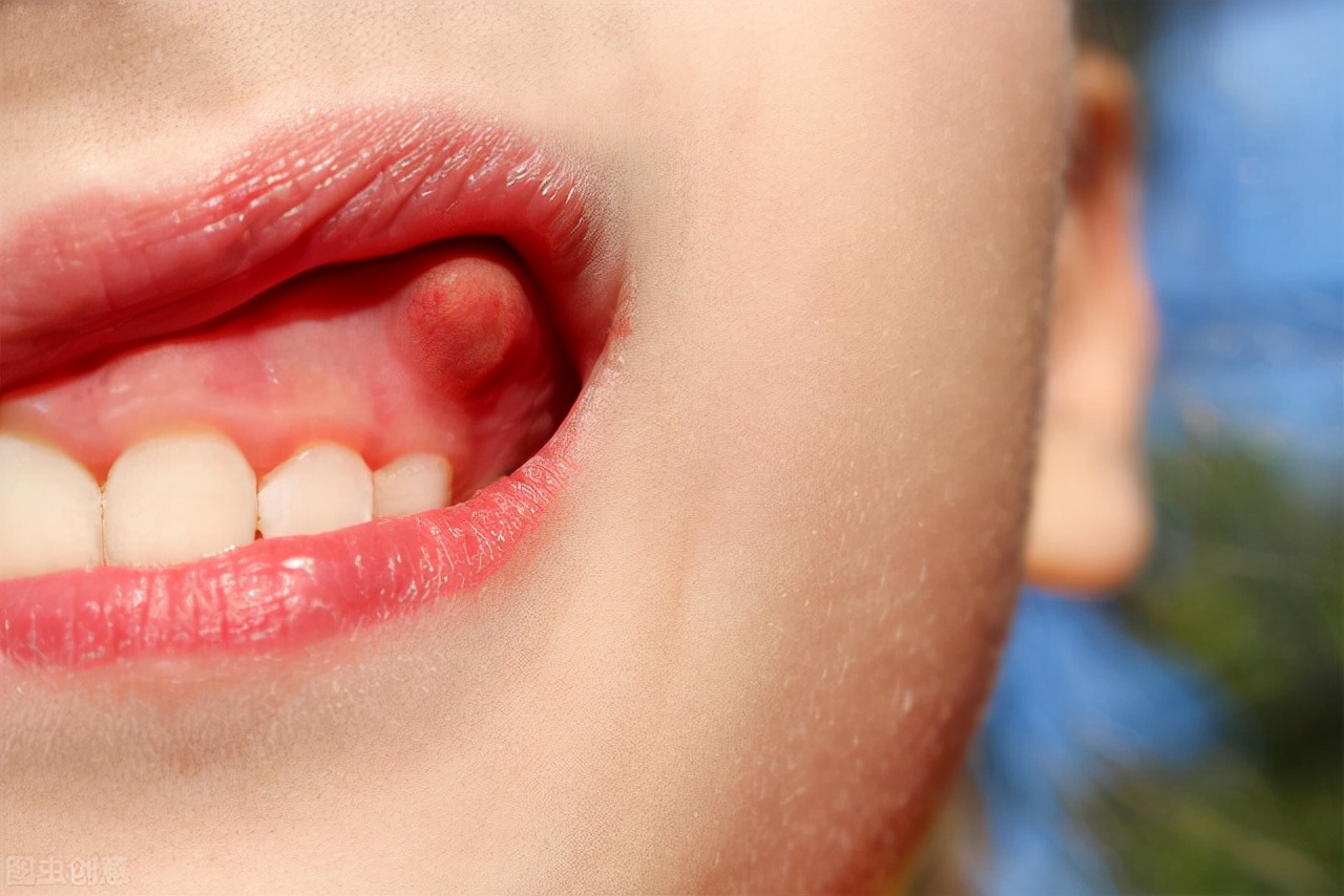 当人得了口腔癌以后,它们就会在口腔内快速增殖,所以口腔里可能会逐渐